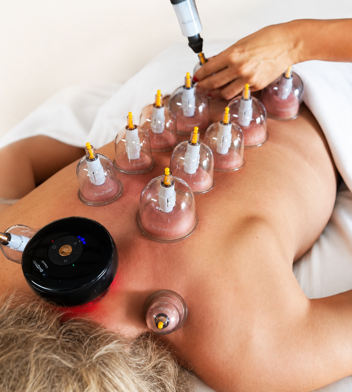 Person receiving cupping therapy with multiple glass cups placed on their back.