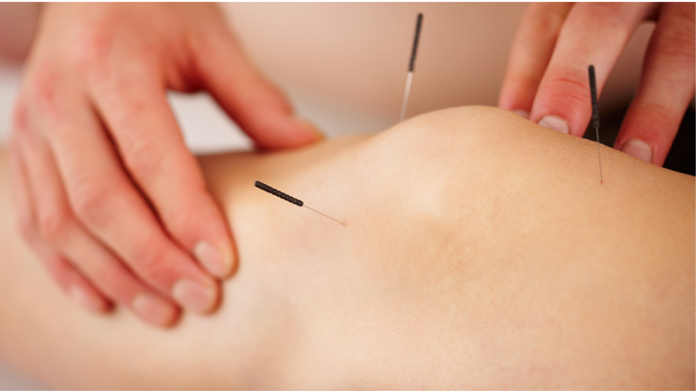 Acupunture