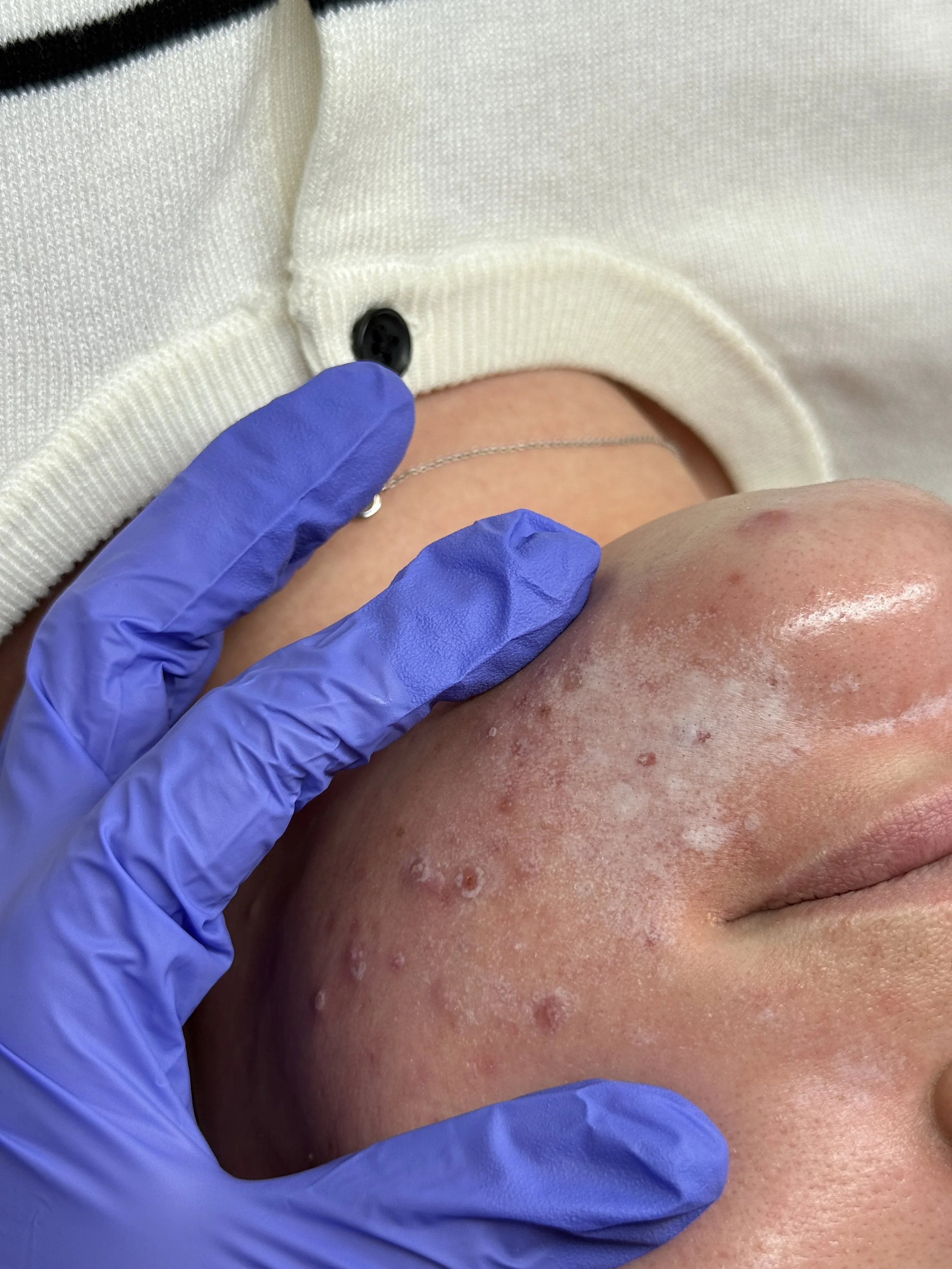 Professional chemical peel treatment for acne, acne scarring, pigmentation, and skin texture performed at NYBGC in Kaysville, Utah.