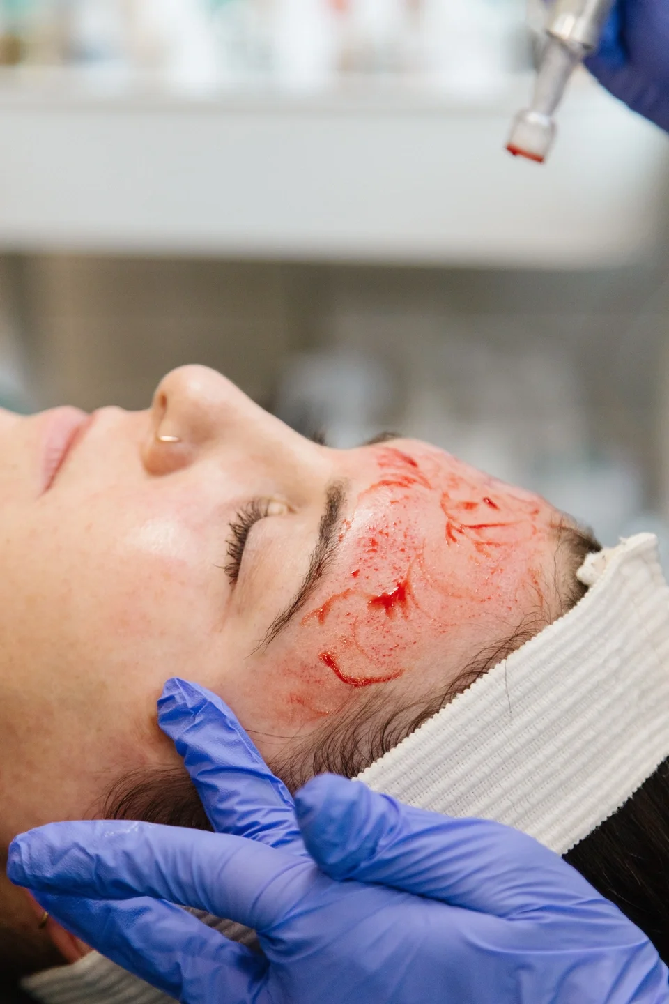Professional microneedling treatment to stimulate collagen, improve acne scars, soften fine lines, and smooth skin texture at NYBGC.