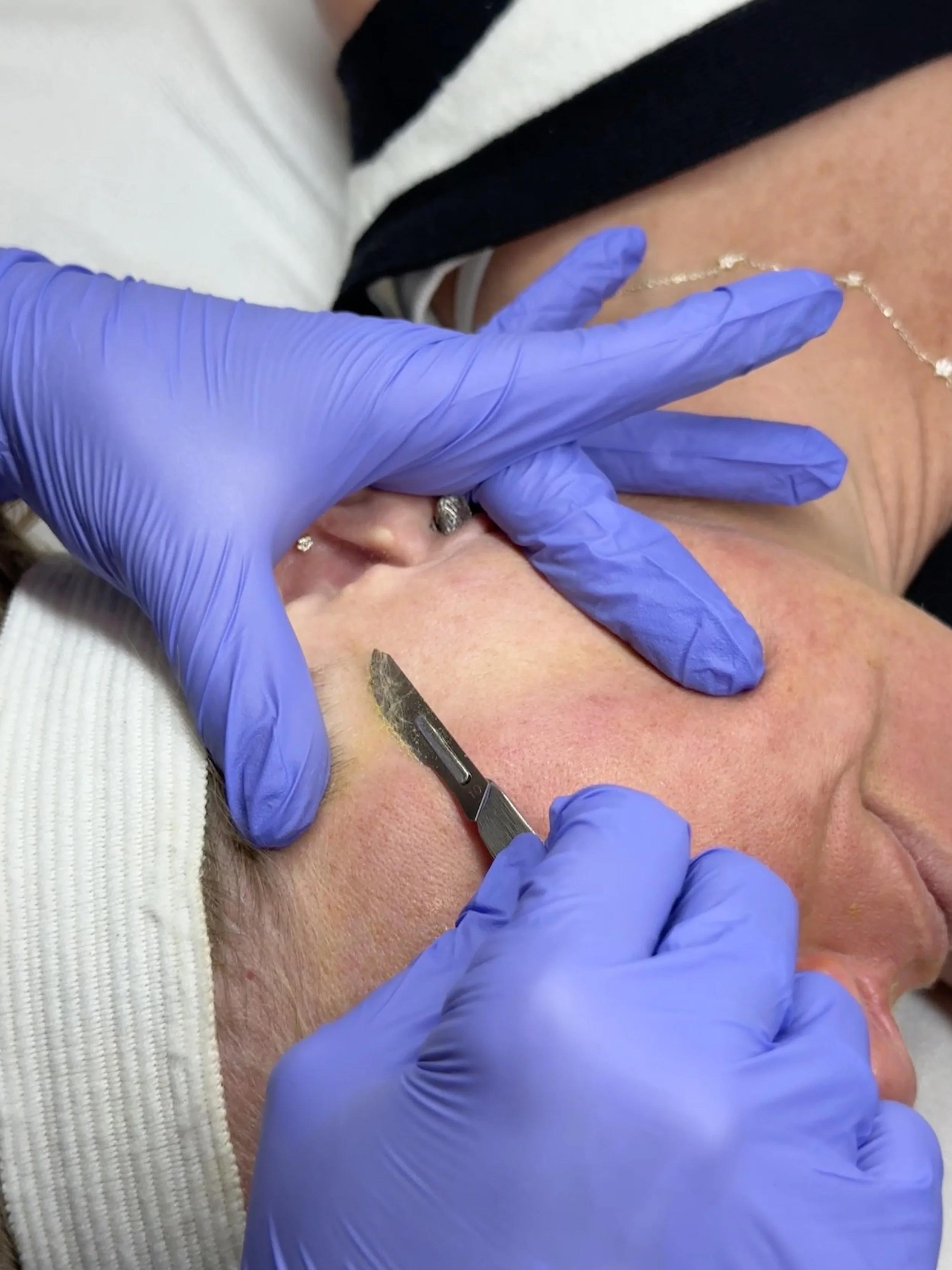 Dermaplaning treatment performed by a licensed esthetician to exfoliate dead skin cells, remove facial hair, and enhance skincare absorption.