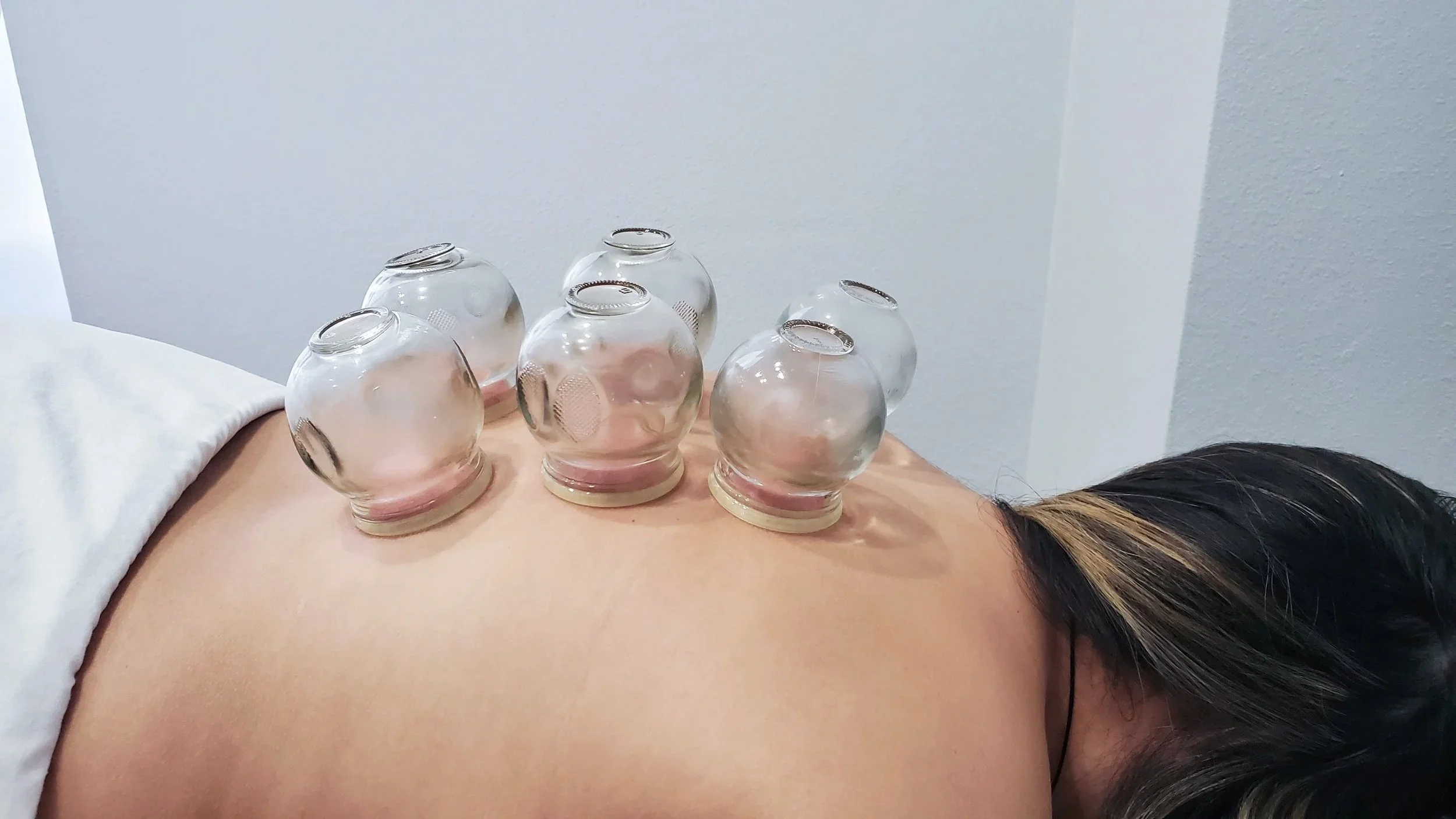 A person lying face down on a therapy table with six glass cupping jars placed on their back for cupping therapy.