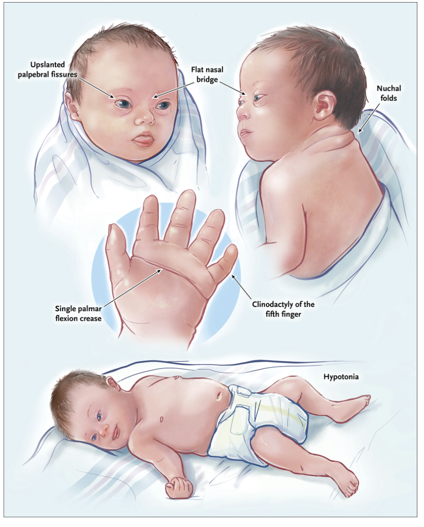 Image from Medline Academics that shows possible conditions associated with Down syndrome.