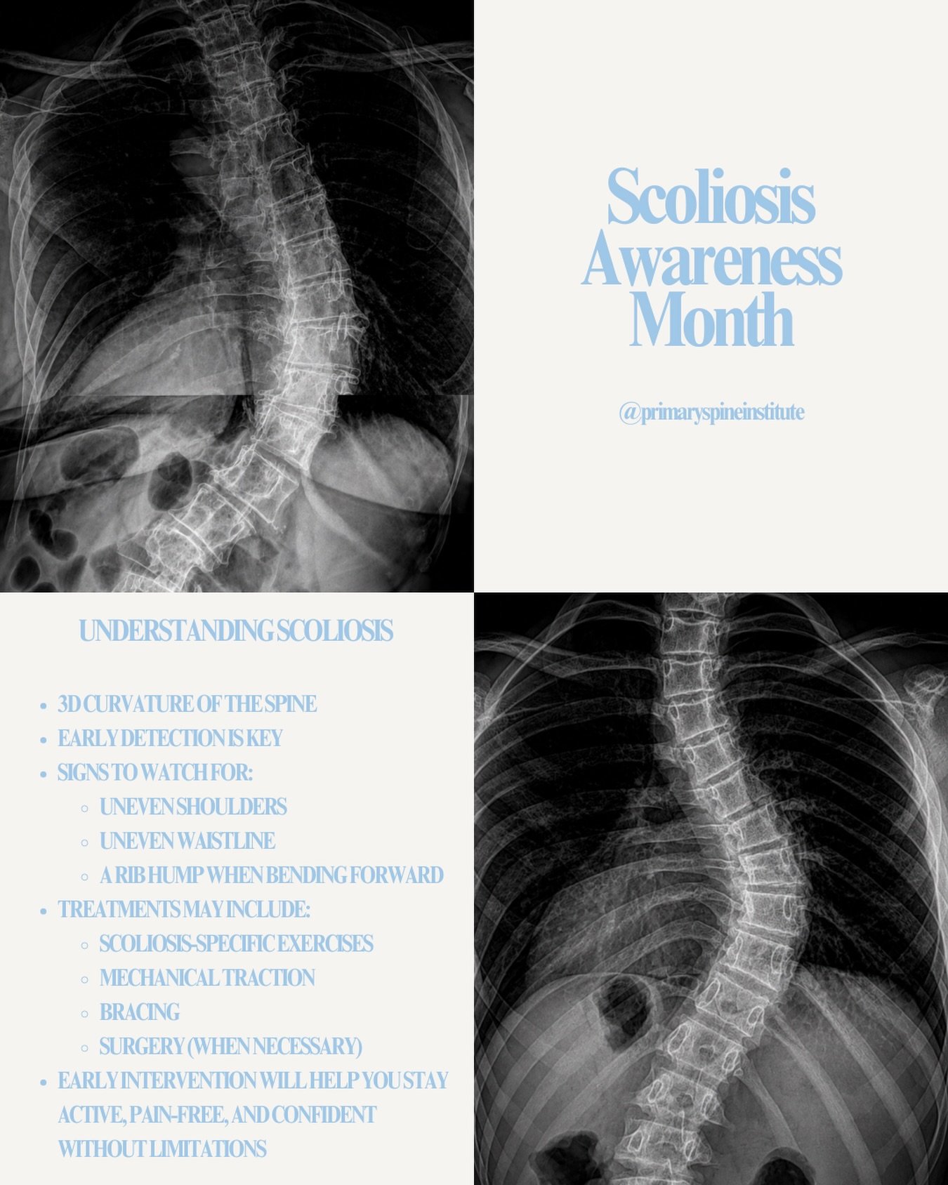 June is Scoliosis Awareness Month💙

☀️ With summer break here and vacations around the corner, NOW is a great time to CHECK-IN.

❓Uneven shoulders ❓Changes in posture ❓One hip sitting higher ❓Clothes fitting unevenly ❓A recent growth spurt

Early de