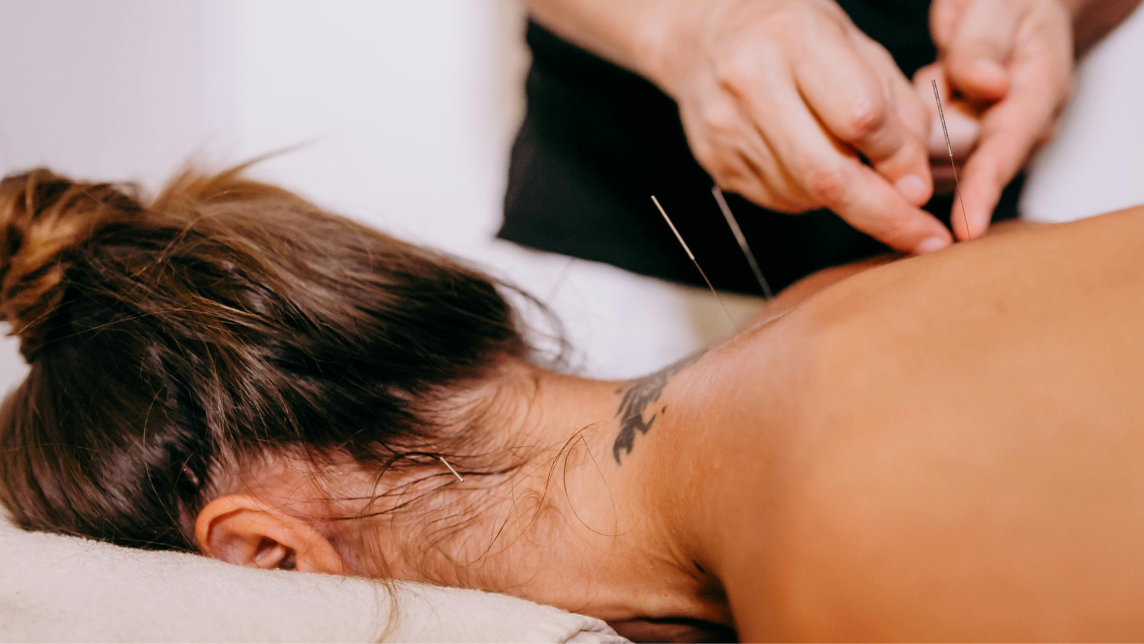 Why acupuncture works for back pain and sciatica — and what most people get wrong