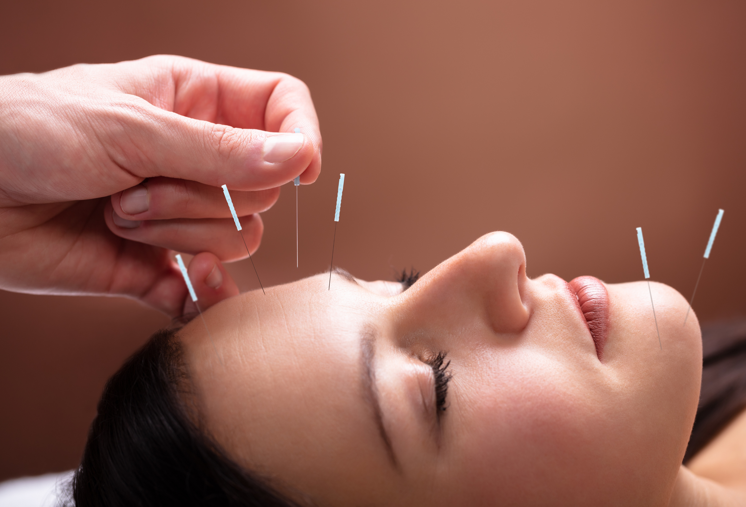 Woman receiving cosmetic facial acupuncture for natural collagen boost and skin rejuvenation in North County