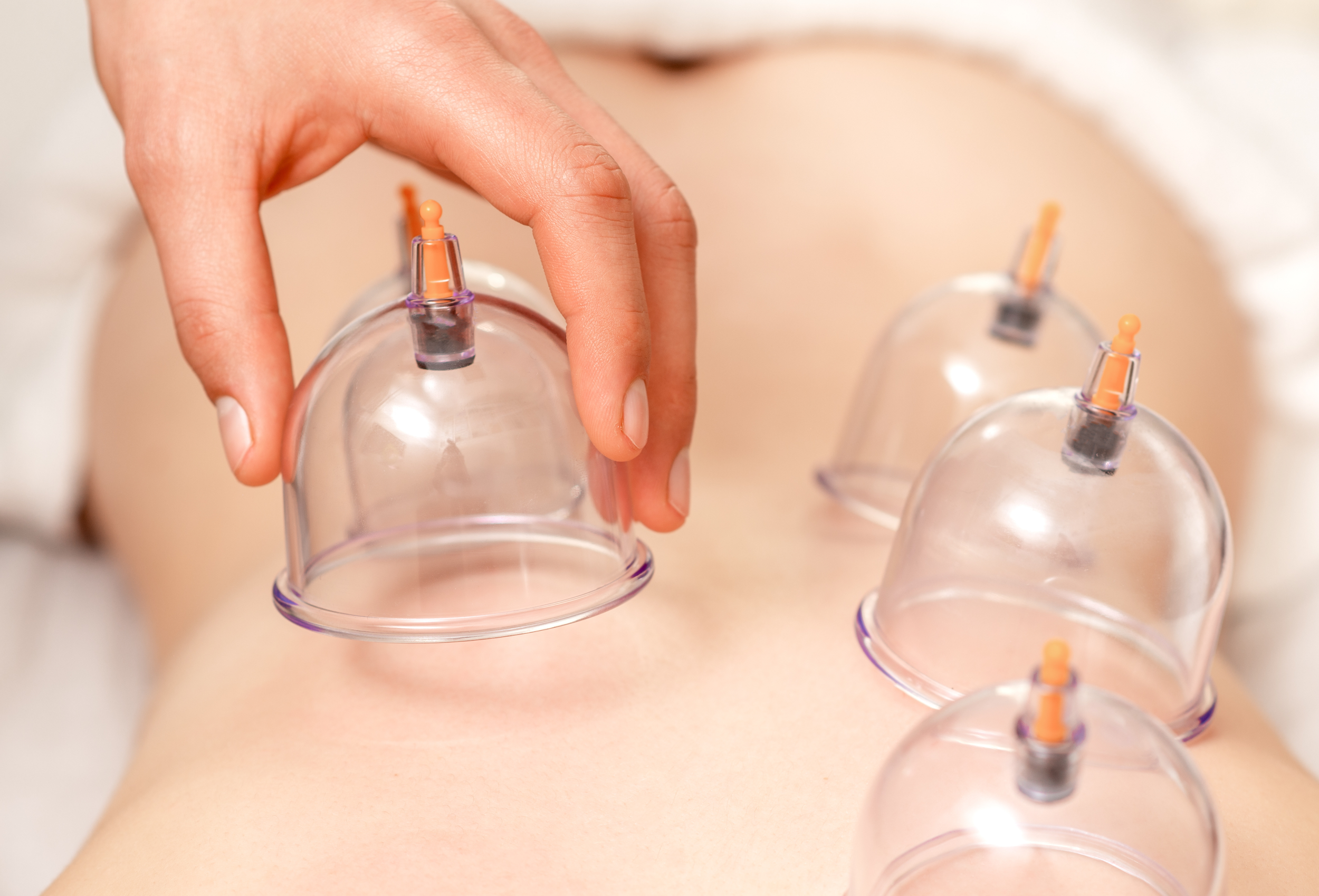 lass cupping therapy session on back for muscle tension and circulation relief