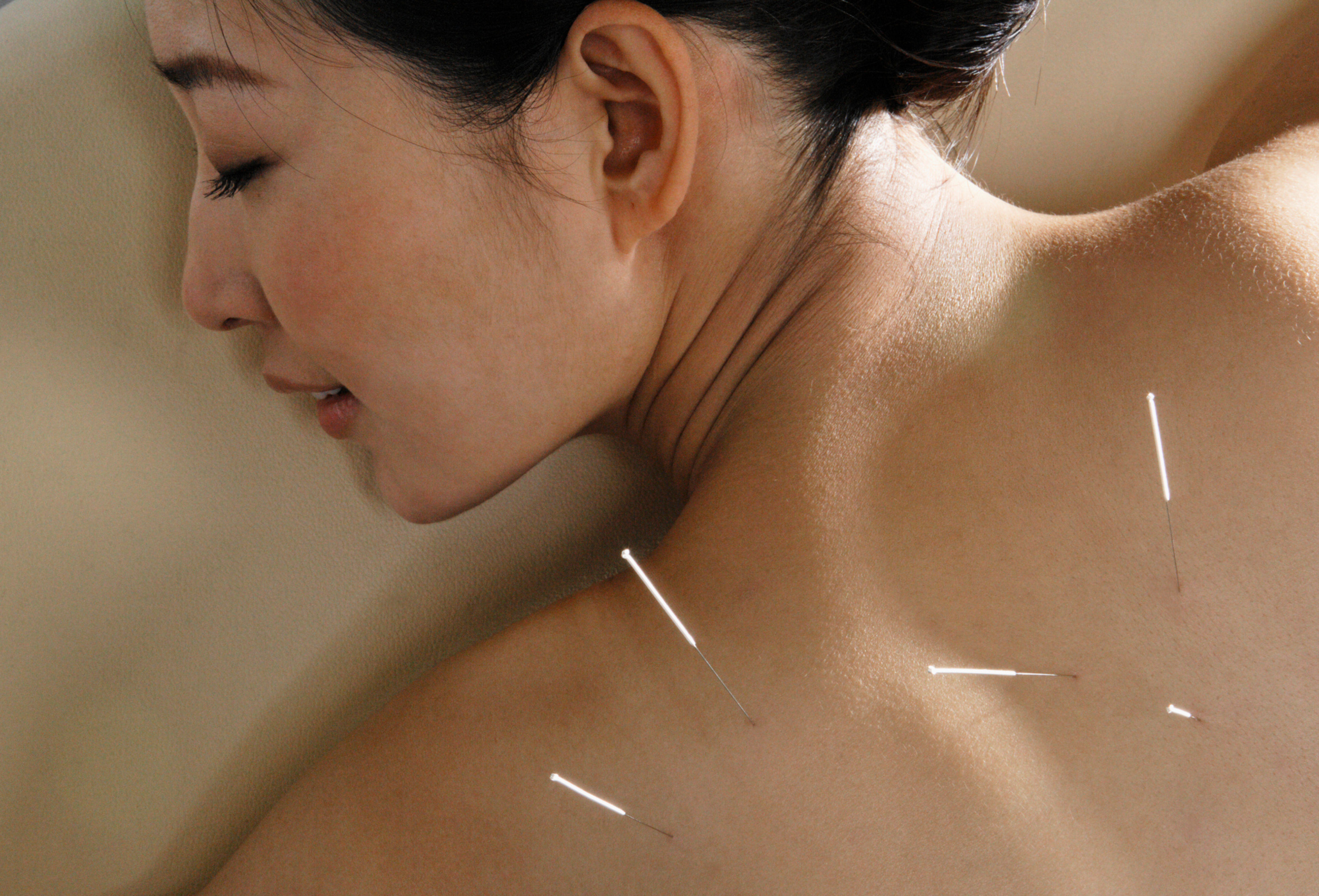 Licensed acupuncturist inserting fine needles during a Traditional Chinese Medicine treatment