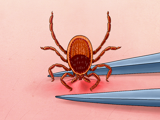 Tick Removal