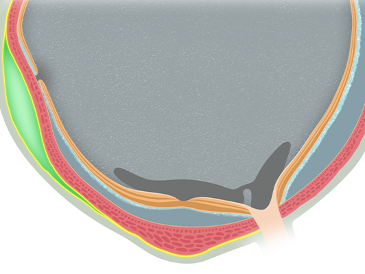 Suprachoroidal Viscopexy
