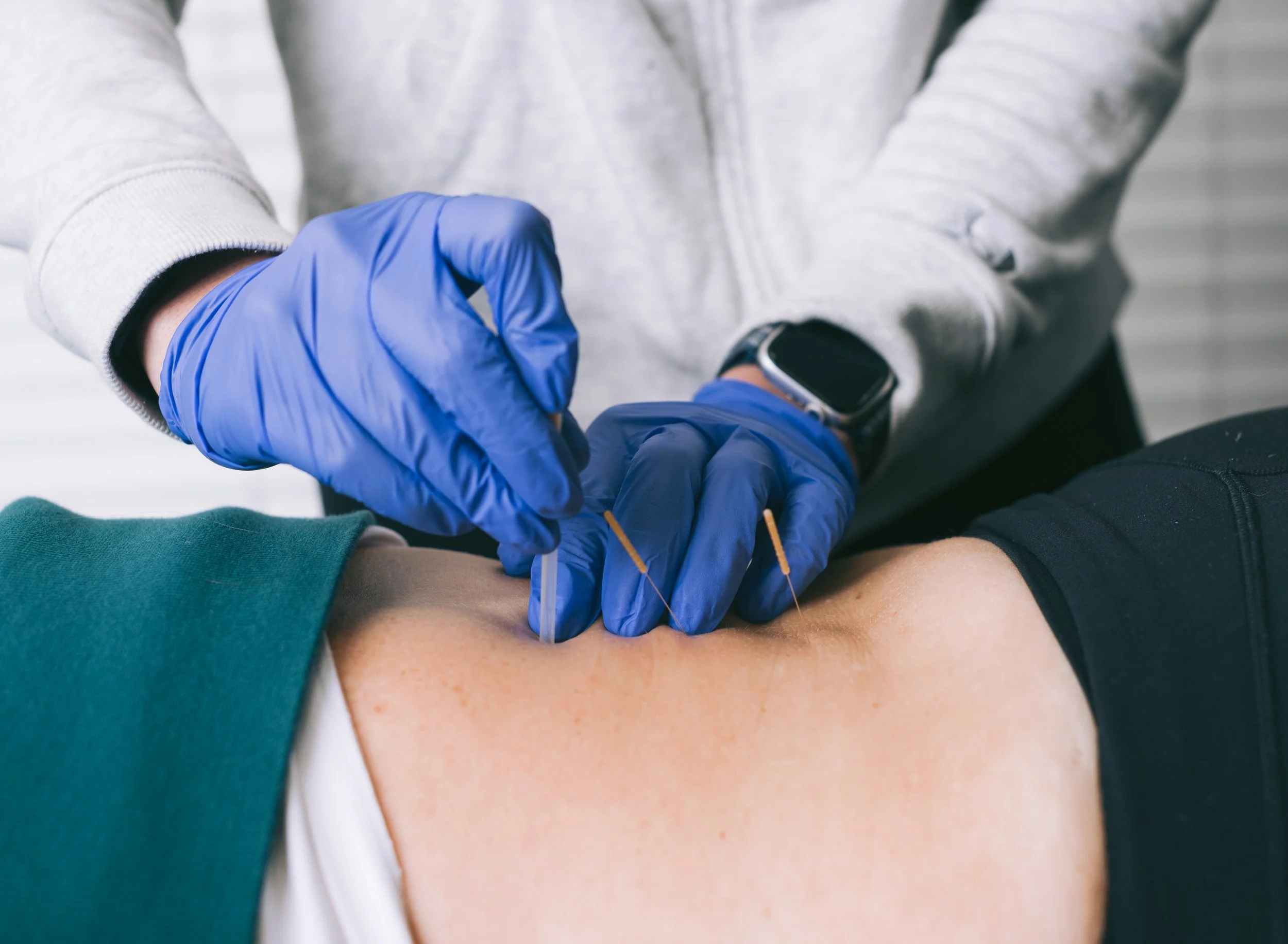 Physical therapist performing dry needling treatment on a patient’s lower back.