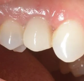 IMPLANTS 2 after.jpg