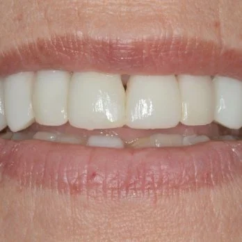 FULL MOUTH RECONSTRUCTION 2 after.jpg