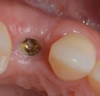 IMPLANTS 2 before.jpg