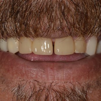 FULL MOUTH RECONSTRUCTION 1 after.jpg