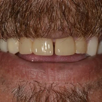 Full mouth reconstruction case 1 after treatment