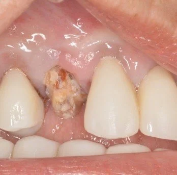 Dental implant case 1 before treatment