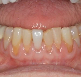 PERIO SX before.jpg
