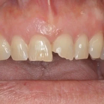 Composite bonding case 3 before treatment
