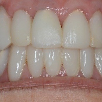 FULL MOUTH RECONSTRUCTION 3 after.jpg