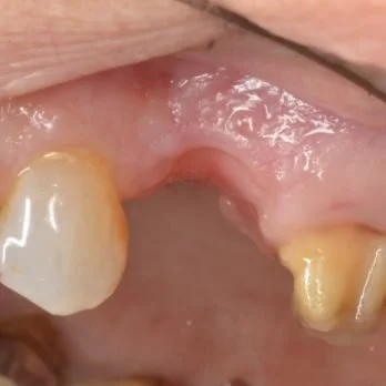 Dental bridge case 1 before treatment