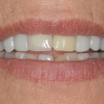 FULL MOUTH RECONSTRUCTION 2 before.jpg