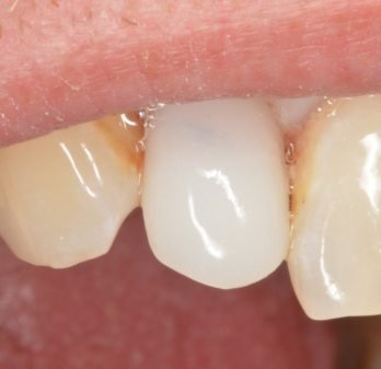 Dental implant case 4 after treatment