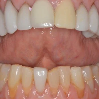 Full mouth reconstruction case 3 before treatment