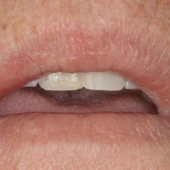 COMPOSITE BONDING 2 after.jpg
