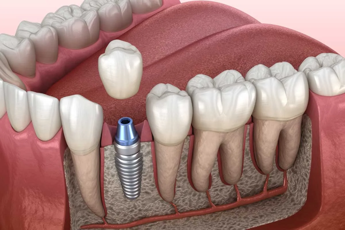 3-What-is-a-Single-Tooth-Implant-2.jpg