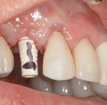 IMPLANTS 3 before.jpg