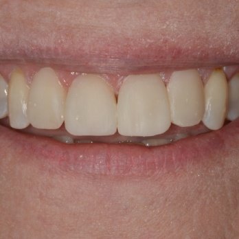 COMPOSITE BONDING 3 after.jpg