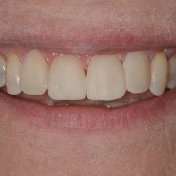 Composite bonding case 3 after treatment