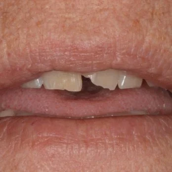 Composite bonding case 2 before treatment