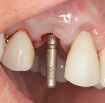 IMPLANTS 1 after.jpg