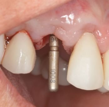 Dental implant case 1 after treatment