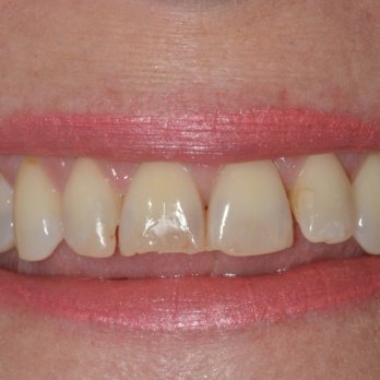 COMPOSITE BONDING 1 before.jpg