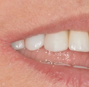 Dental implant case 3 after treatment
