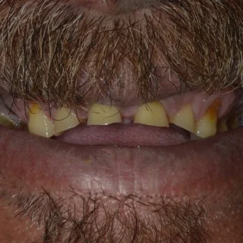 Full mouth reconstruction case 1 before treatment