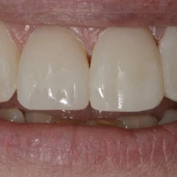 Composite bonding case 1 after treatment