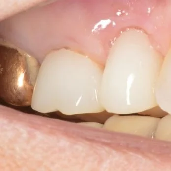 Dental bridge case 1 after treatment