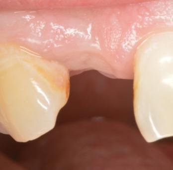 IMPLANTS 4 before.jpg