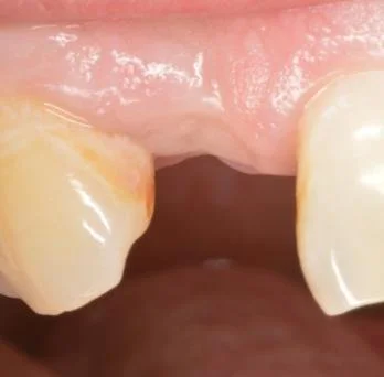 Dental implant case 4 before treatment