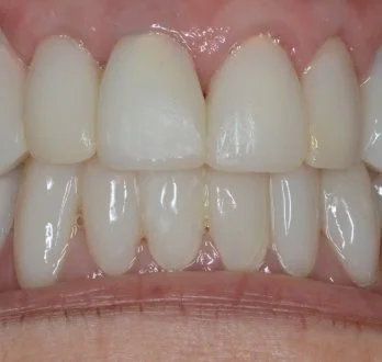 PERIO SX after.jpg