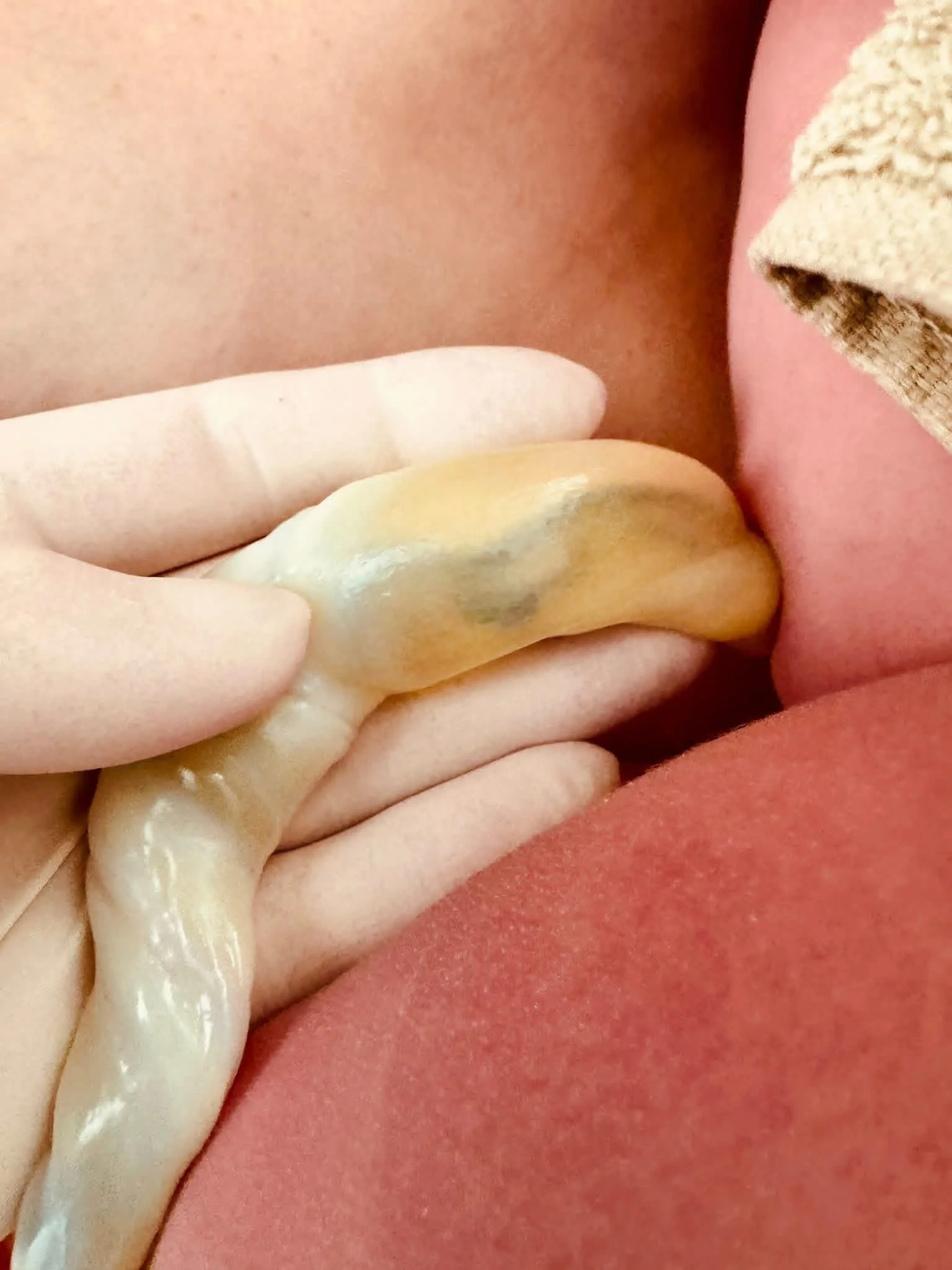 Close-up of a person with a medical glove near their skin, with a towel and a pink cloth nearby.