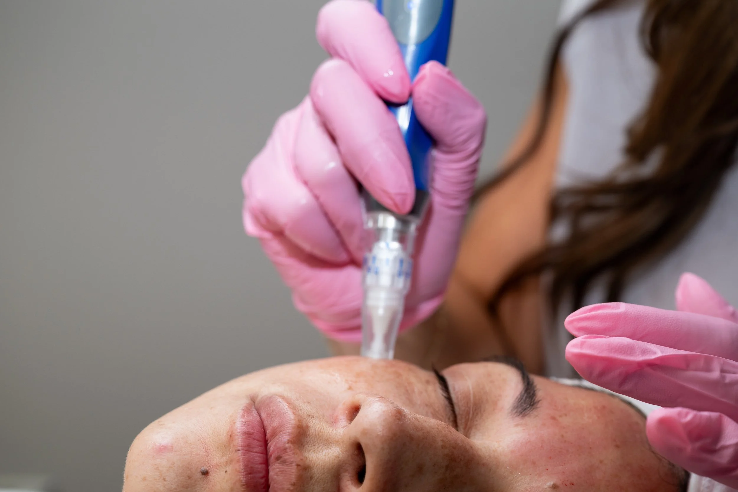 Microneedling treatment performed during a Bella Derma patient appointment.