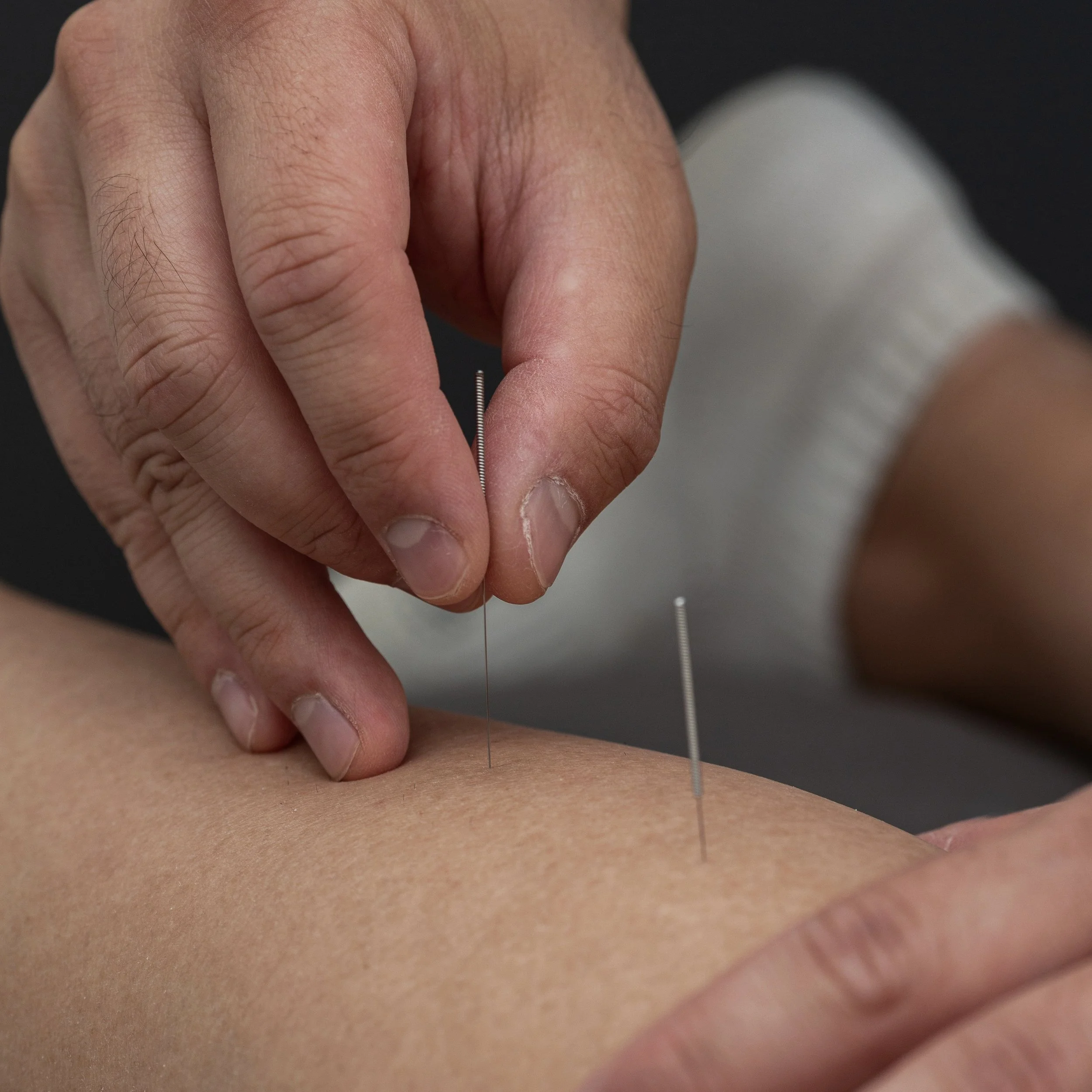 Acupuncture treatment targeting muscle tension and recovery performed by a Registered Massage Therapist.