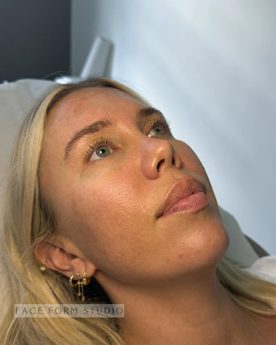 Close-up of a woman with blonde hair and multiple earrings, lying back with her head slightly tilted upward, in a clinical setting for face treatment.