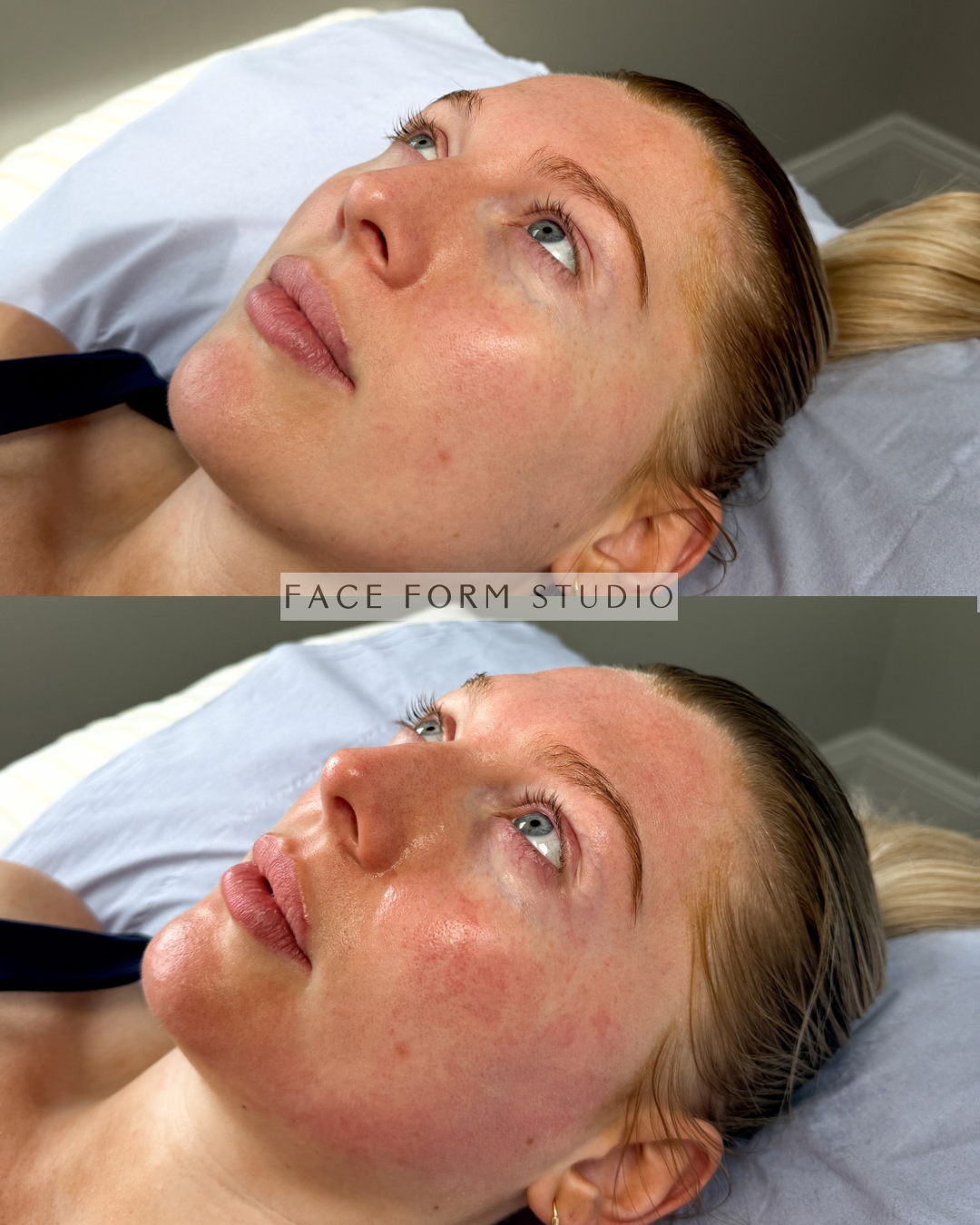A woman lying on her back on a bed, undergoing a facial treatment with visible redness and irritation on her face, in a studio setting.