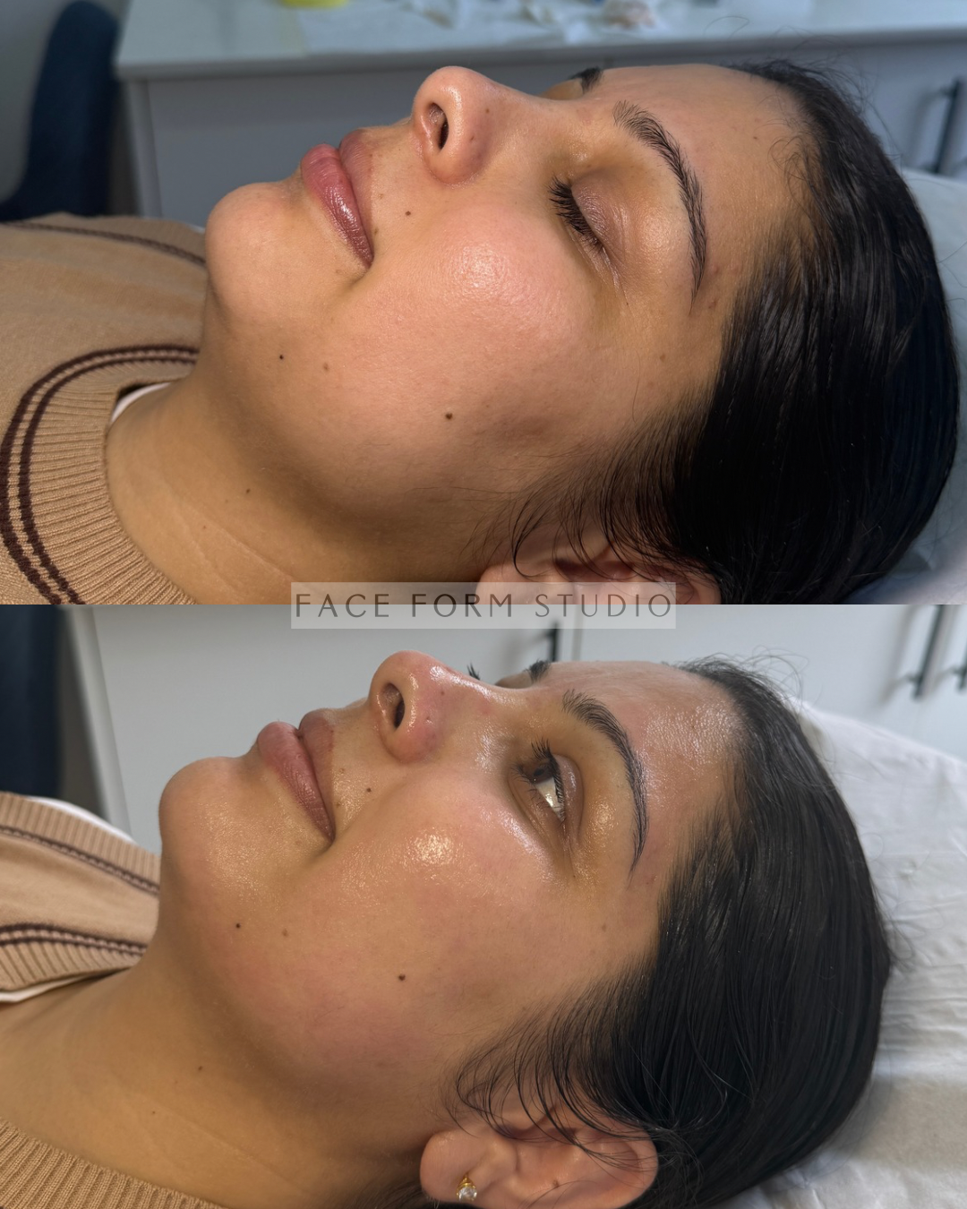 A woman lying on a bed with her eyes closed, showing a before-and-after comparison of her facial skin, which appears smoother and more radiant in the after photo.